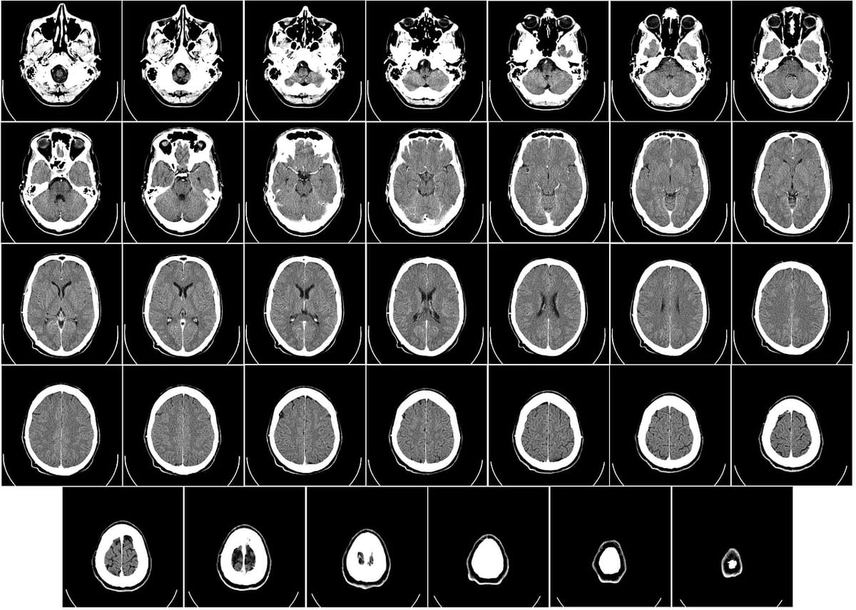 Cómo la ketamina puede cambiar el cerebro para combatir la depresión