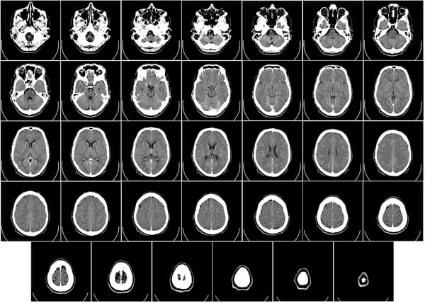 Cómo la ketamina puede cambiar el cerebro para combatir la depresión